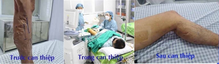 Người bệnh từ Nghệ An đến BVĐK Phú Thọ điều trị suy giãn tĩnh mạch chi dưới